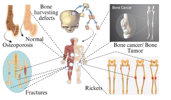 Advances in Bone Tissue Engineering: 4D Printing for Dynamic and Adaptive Bone Implants