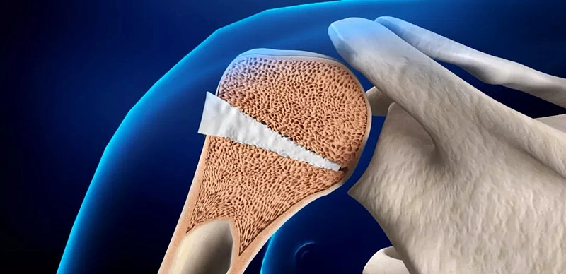 From customization to repair: Adventure Technology realizes a comprehensive solution for ceramic 3D printing artificial bone repair materials and equipment