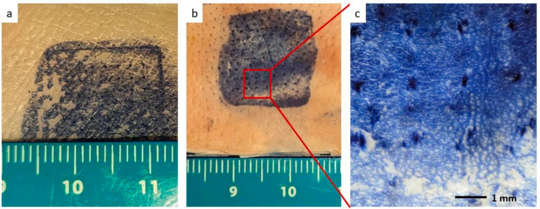 Industry Insights | Using DLP 3D Printing to Manufacture Low-Cost Conical Microneedles