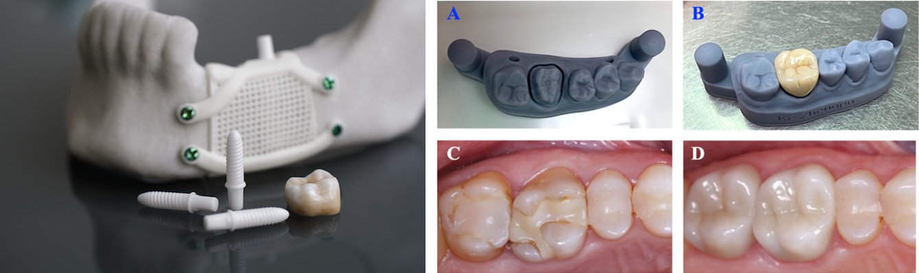 3D-printed zirconia dental